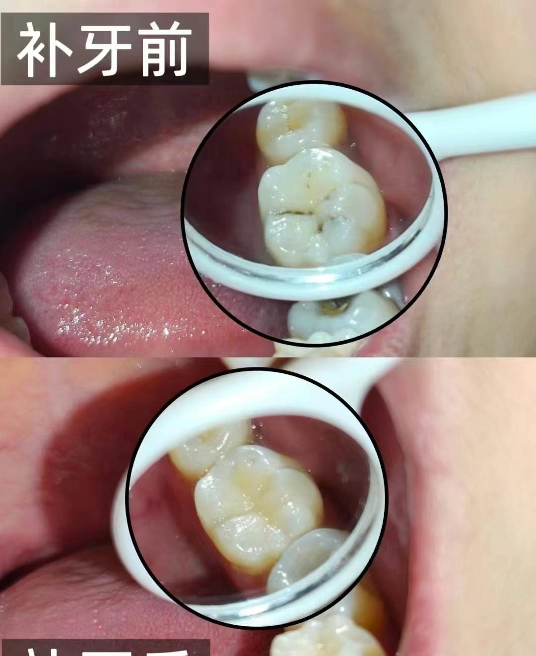 蛀牙一定要补牙吗