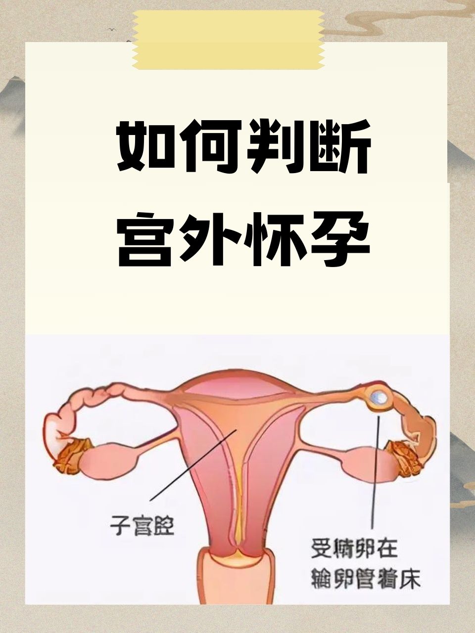 宫外孕早期症状