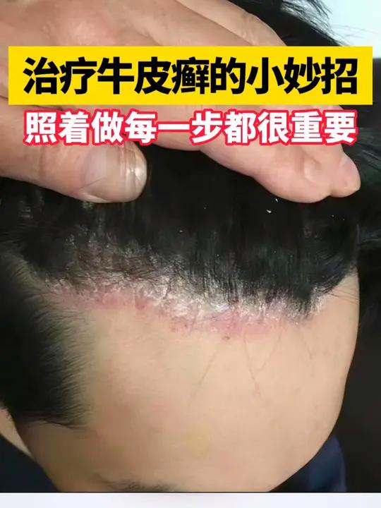 牛皮癣真的不传染吗