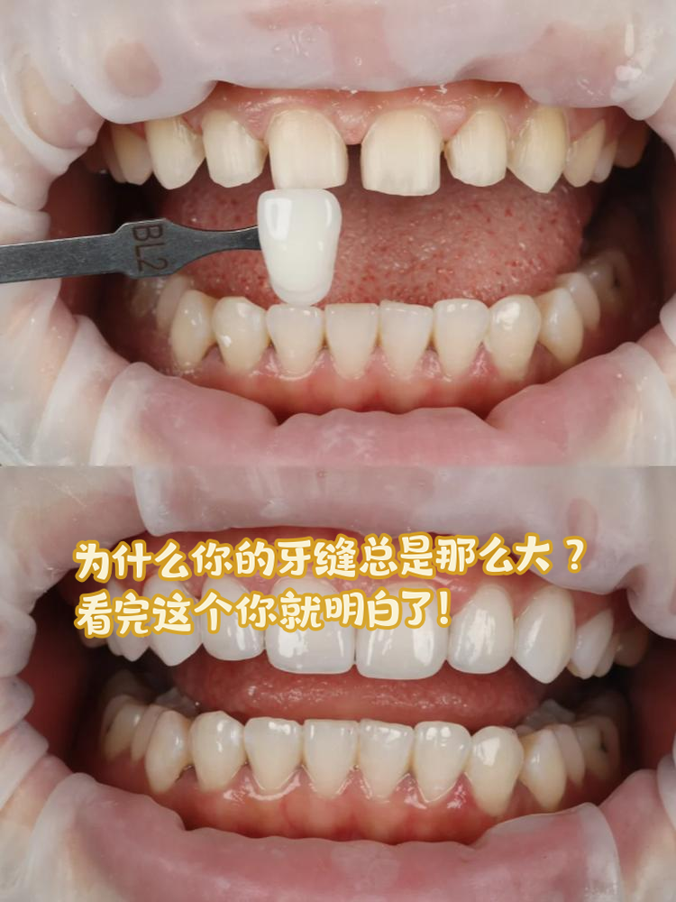 牙缝大是什么原因引起的