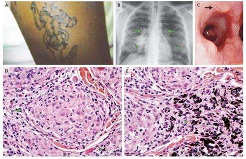 什么是变应性血管炎