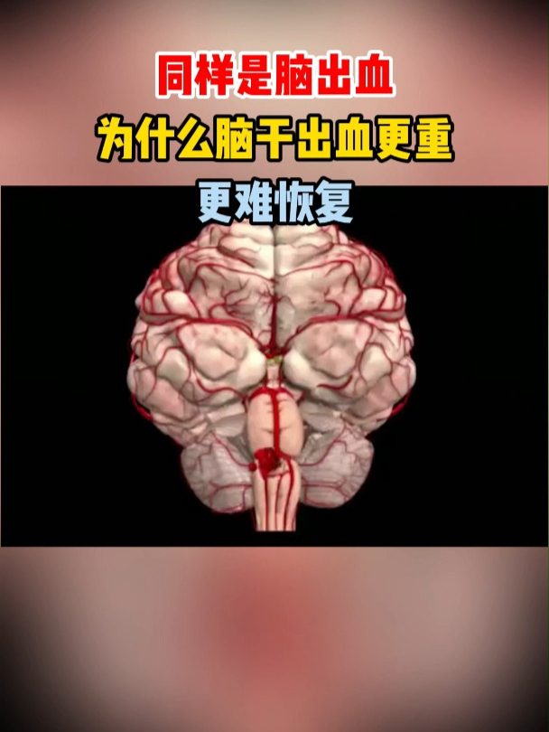 脑出血严重吗