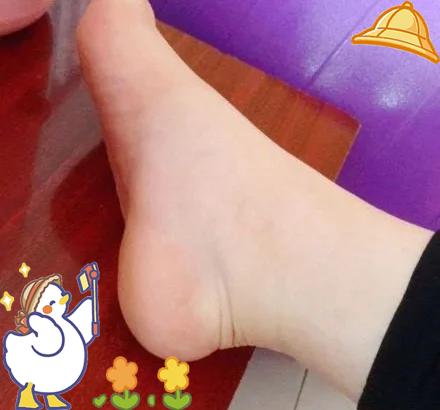 孕期脚肿是什么原因
