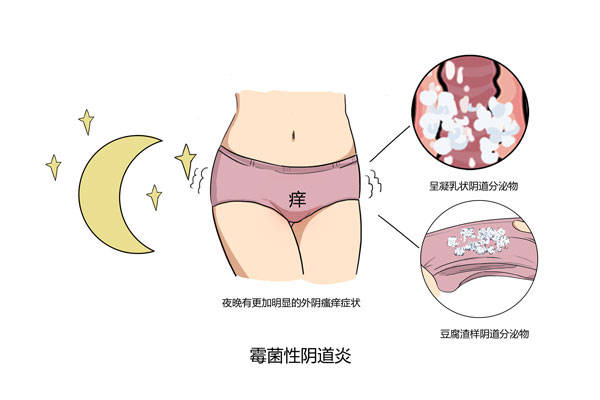 女性阴道炎的危害有哪些