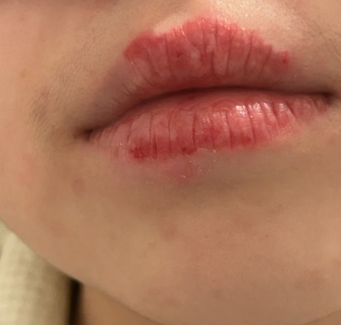 口周皮炎如何治疗