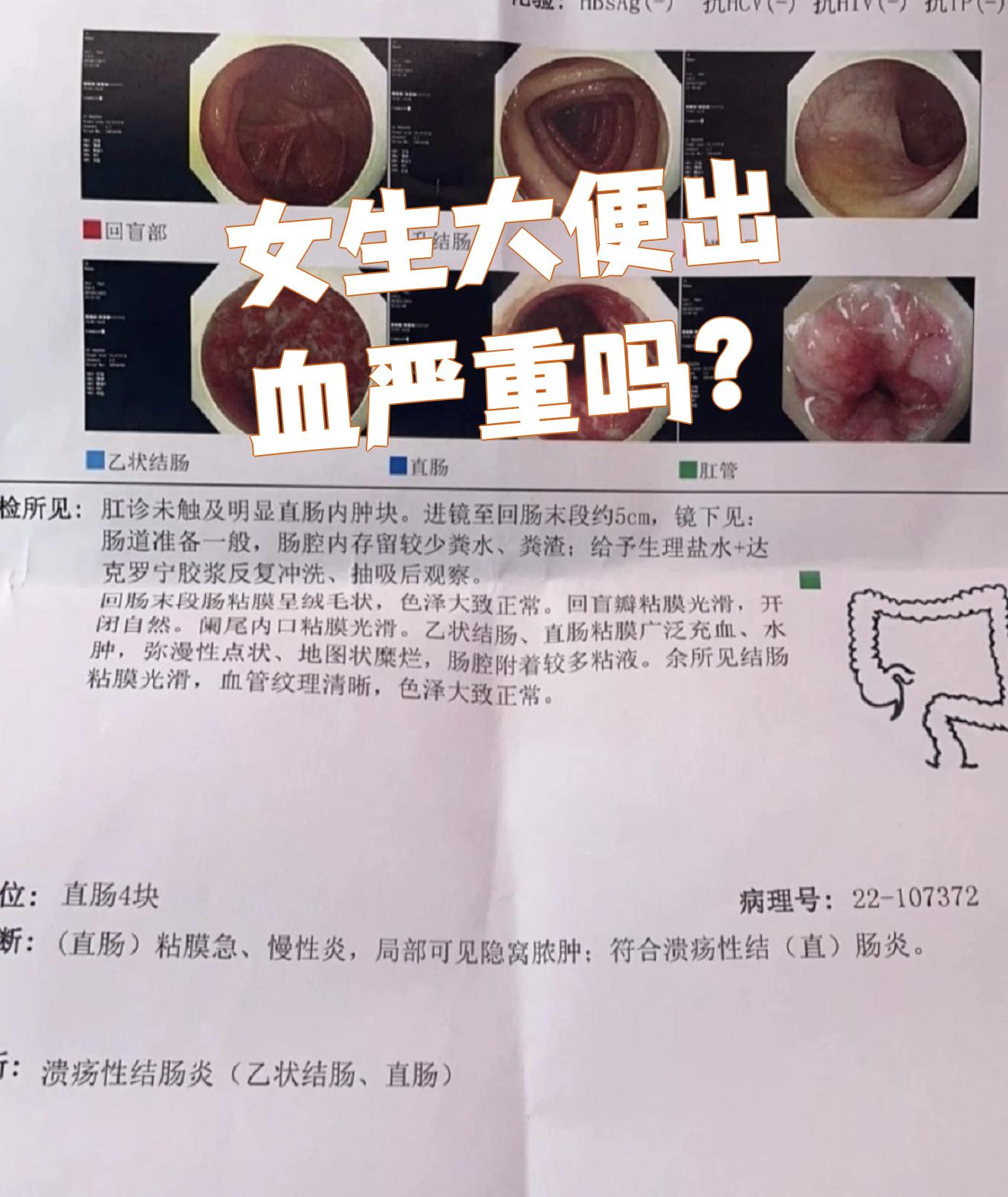 上厕所大便出血是什么原因