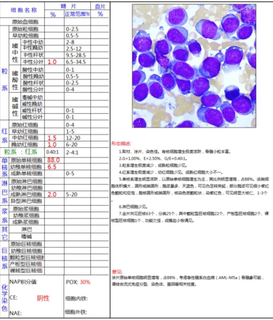 急性髓系白血病,m2