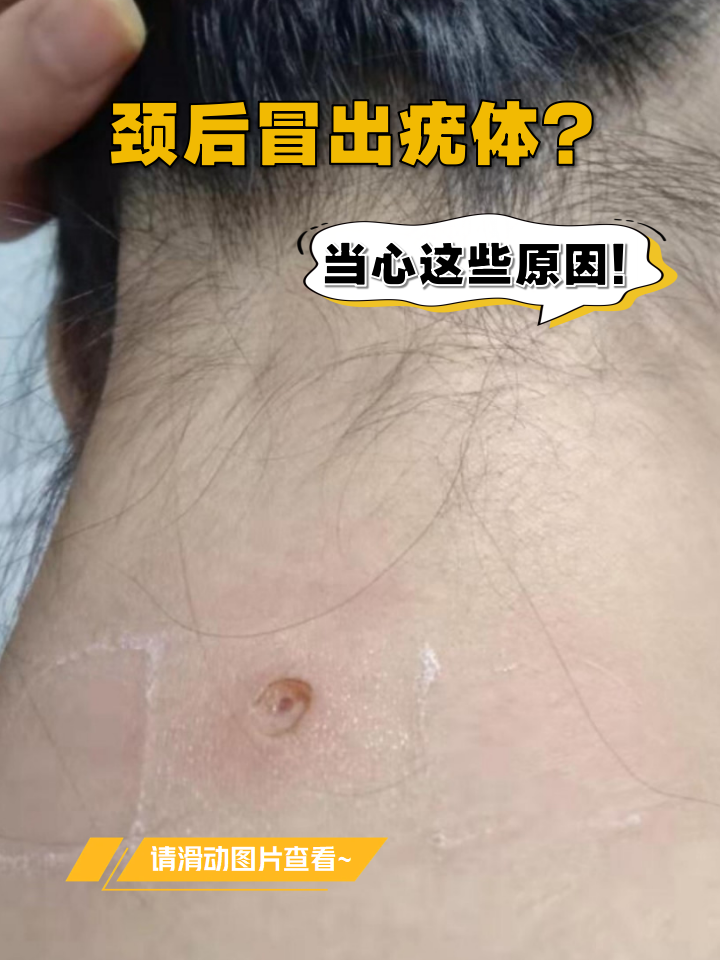 脖子上长肉疙瘩怎么办