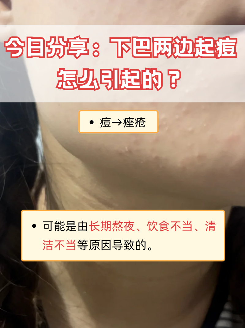 痤疮怎么回事