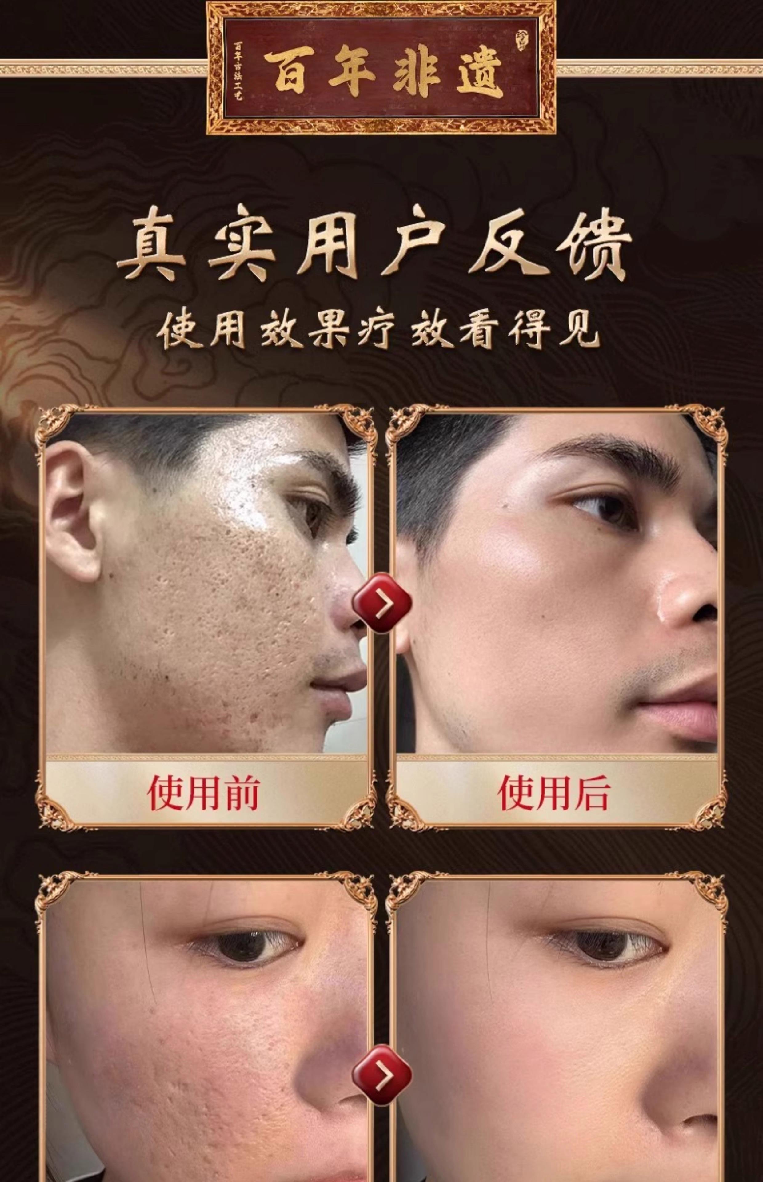 激光去痘坑有副作用吗