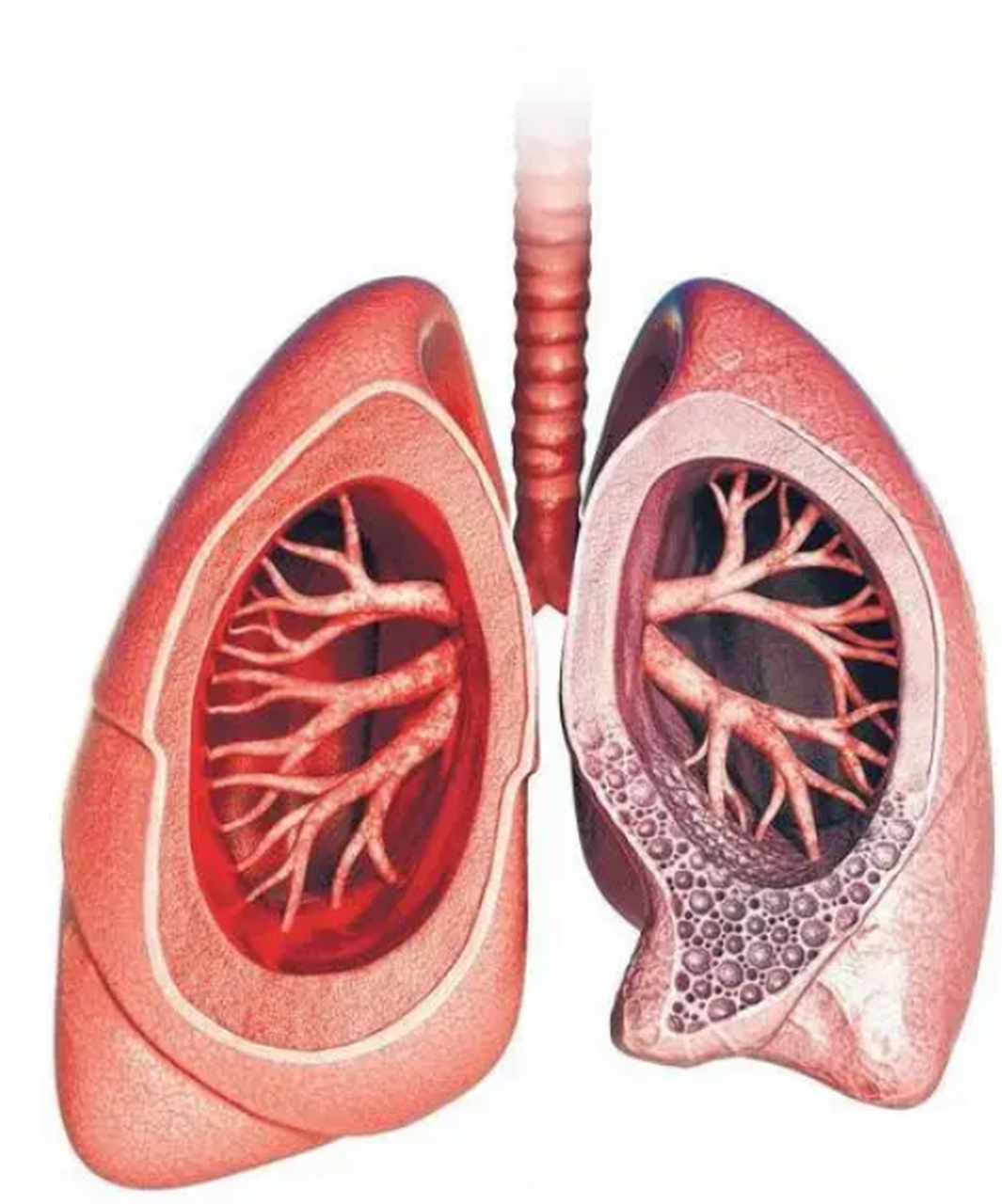 肺纤维化可以治愈吗?
