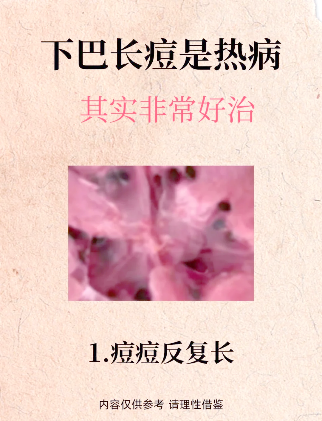 为什么下巴总是长痘