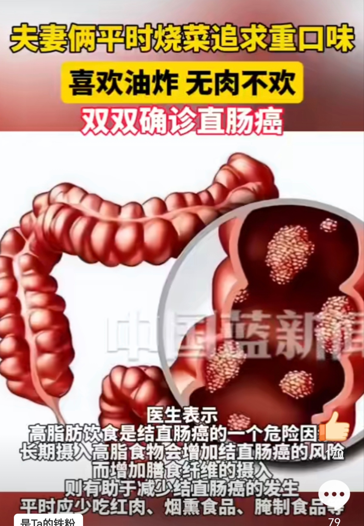 直肠癌能彻底治好吗?