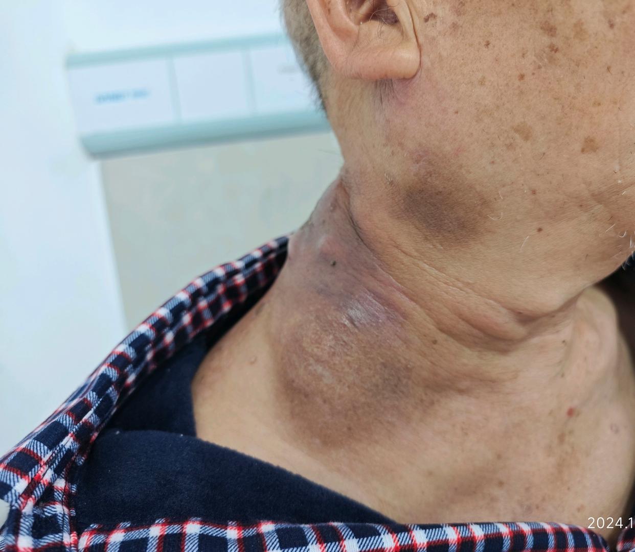 淋巴癌晚期有什么表现症状