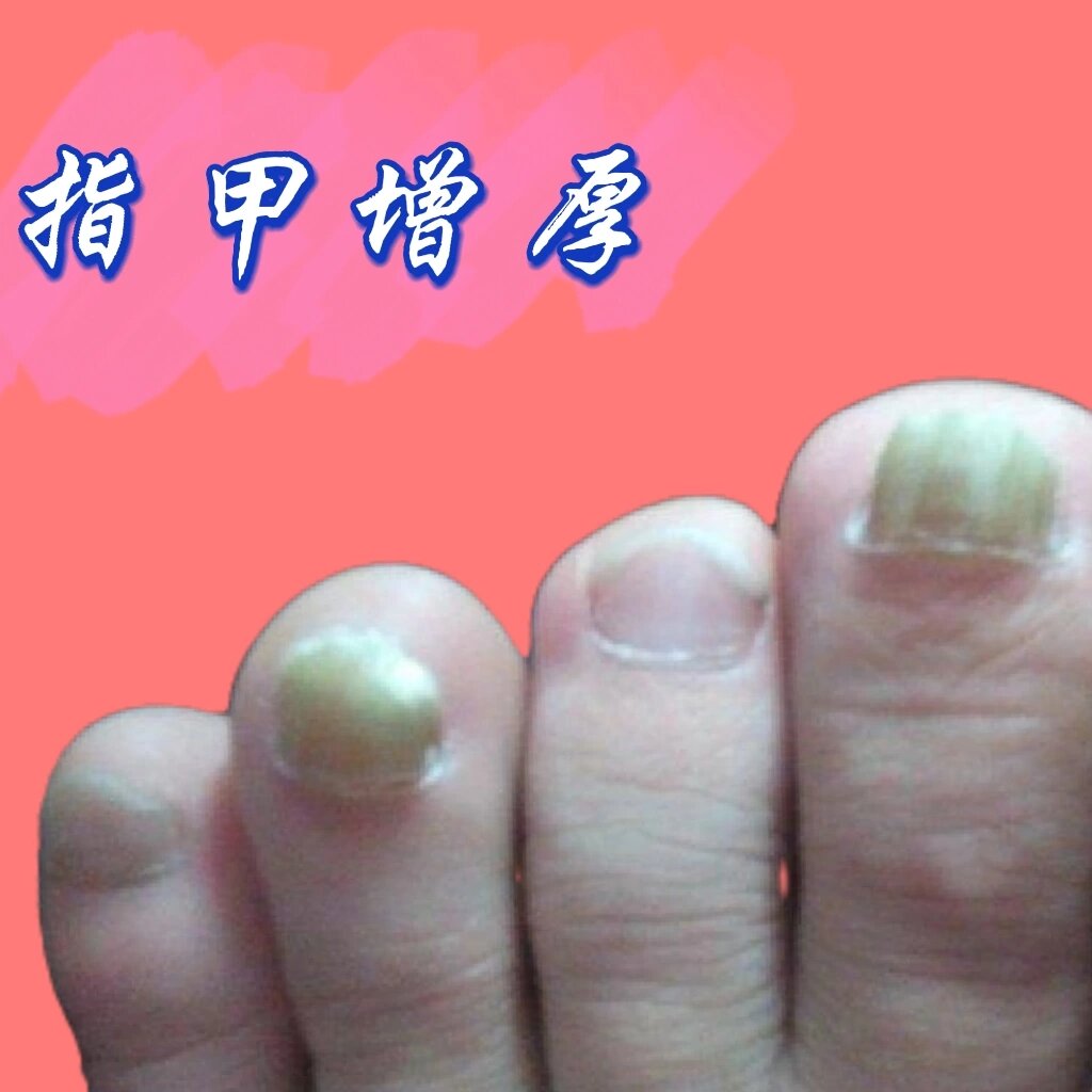 脚趾甲变厚变黄是怎么回事