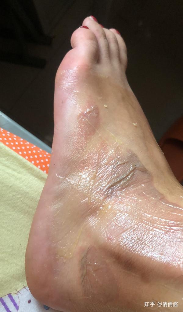 浅二度烧伤多少天能好