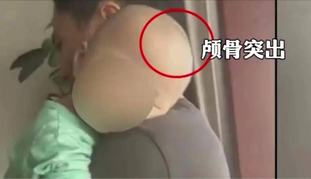 颅骨突出