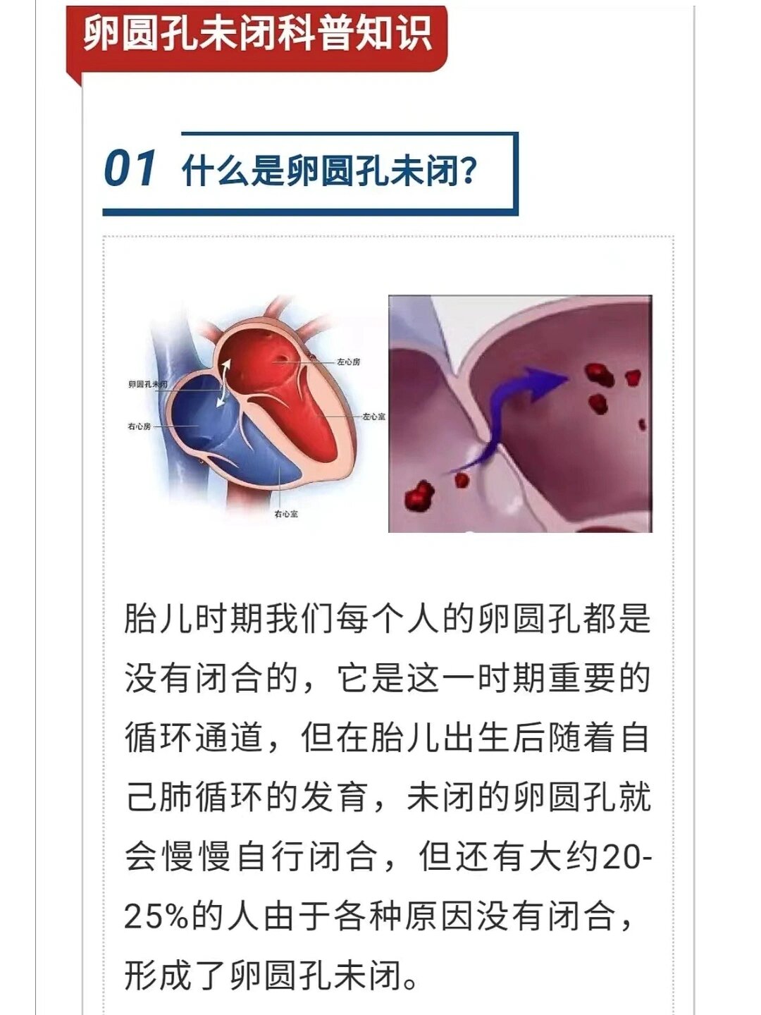 婴儿卵圆孔未闭怎么办