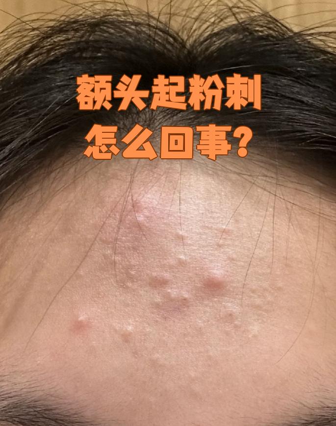 额头上长粉刺是什么原因