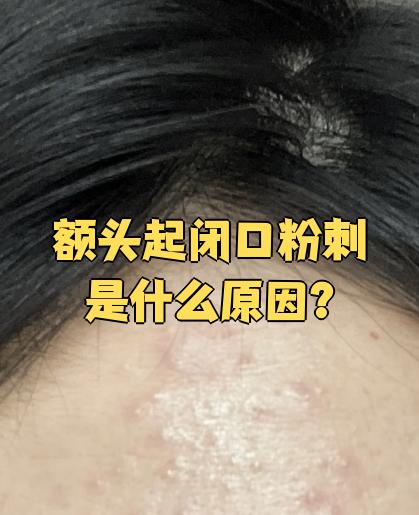 额头上长粉刺是什么原因