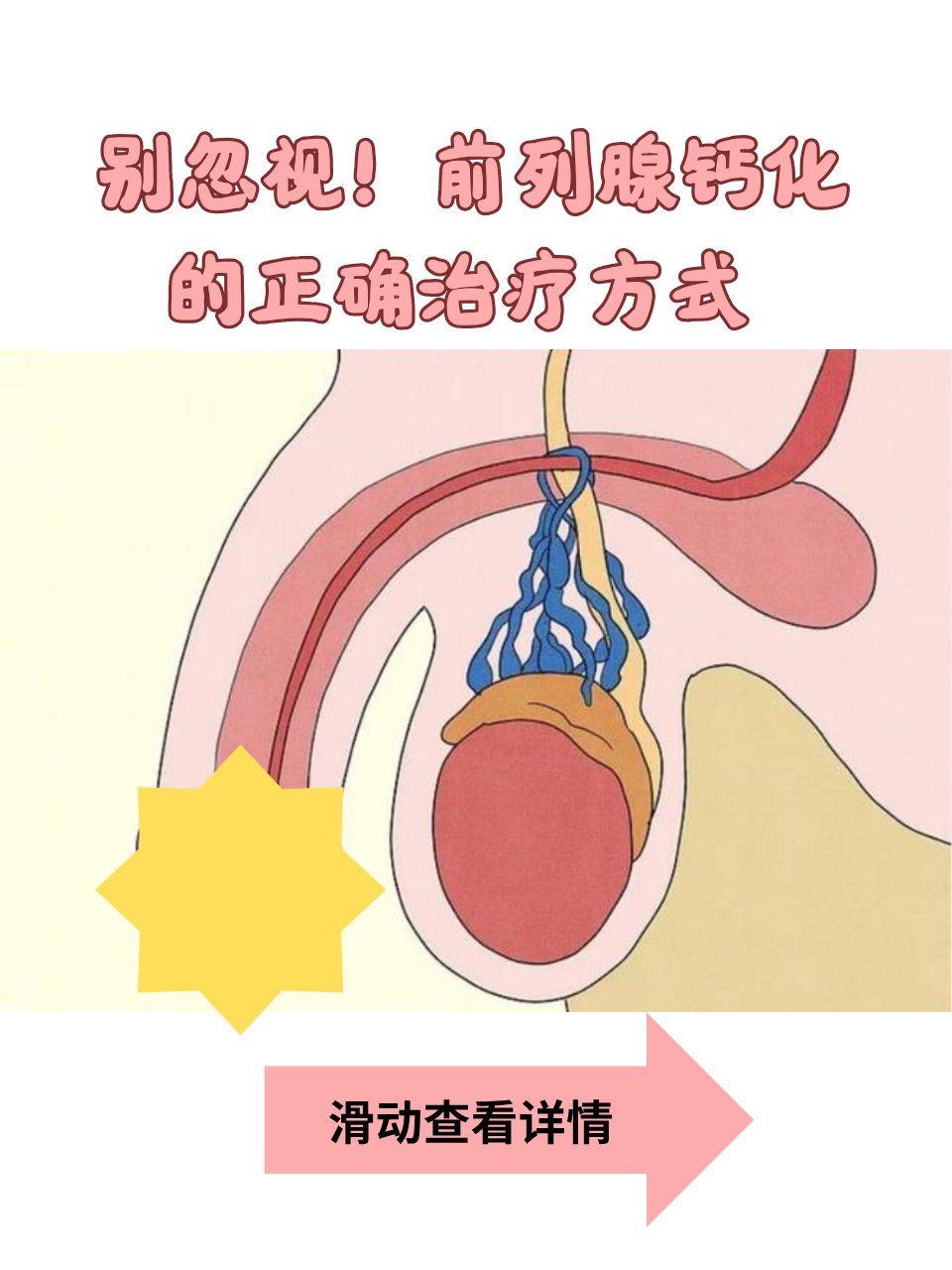 前列腺钙化能治好吗
