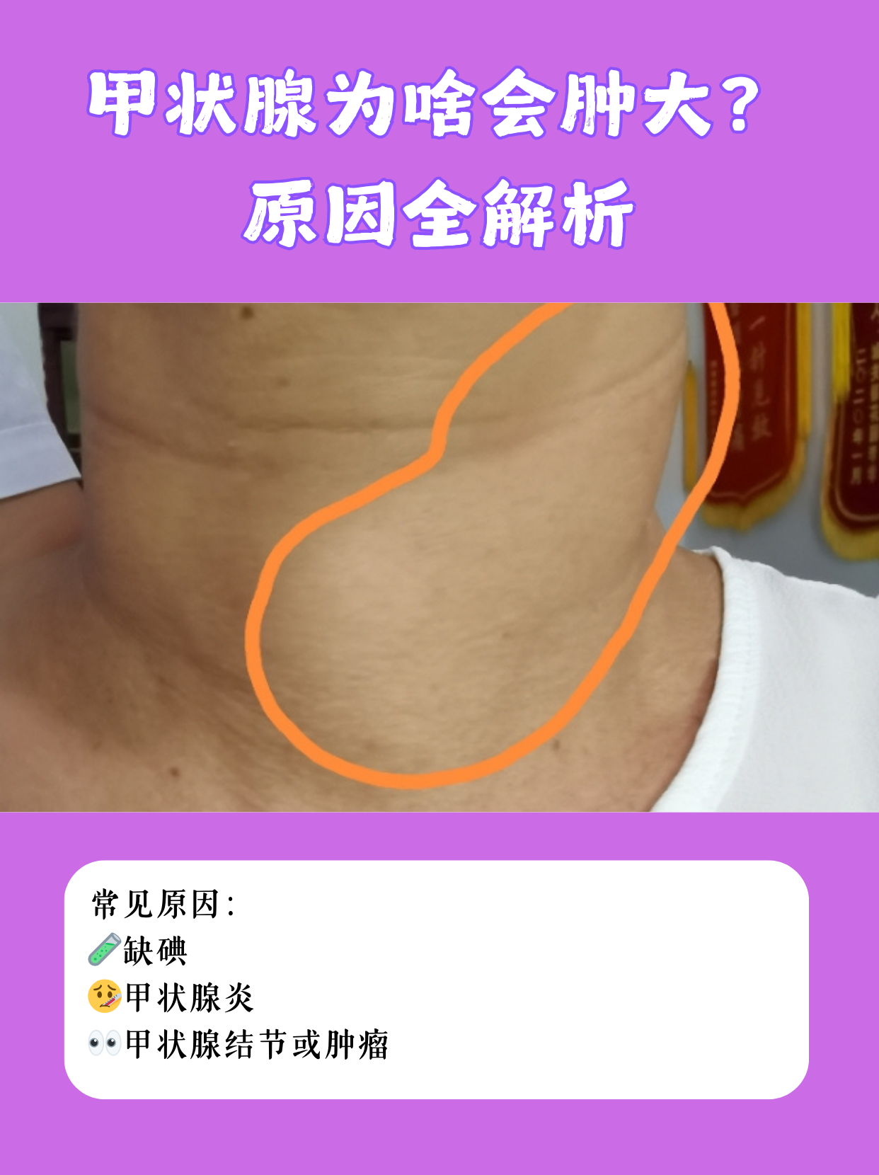 甲状腺正常值多少,??