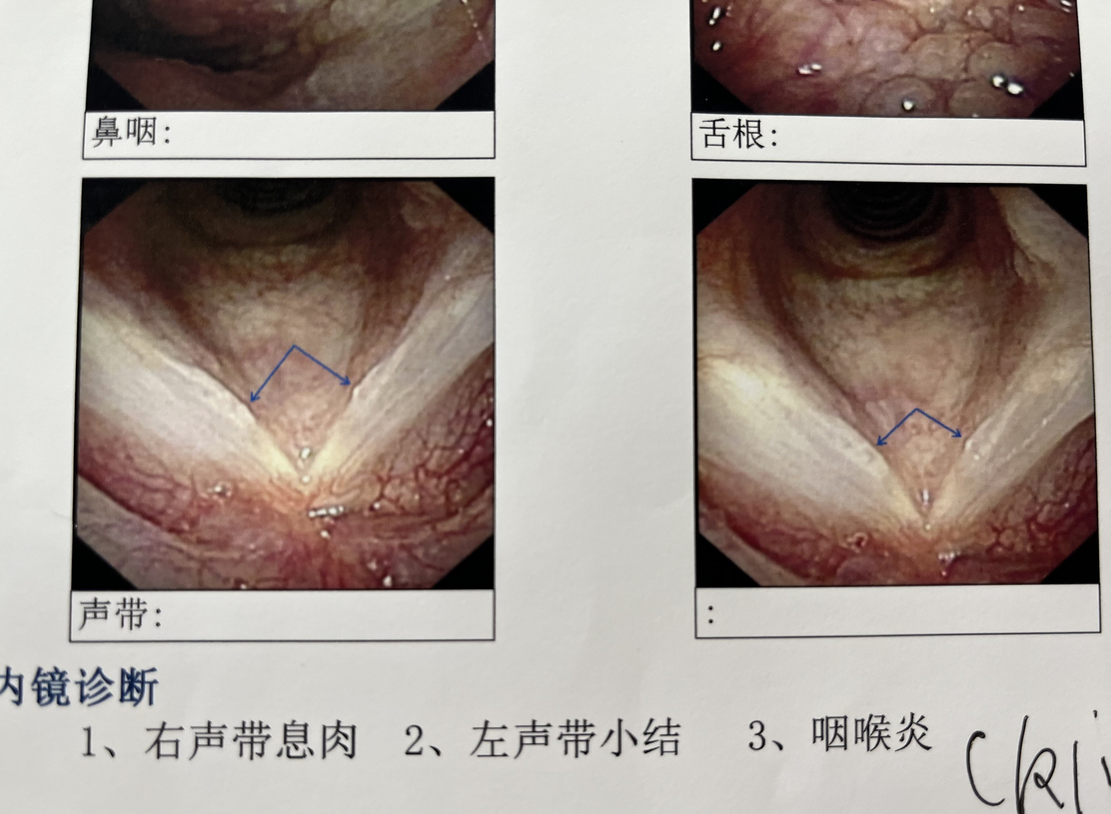 声带息肉手术危险吗?