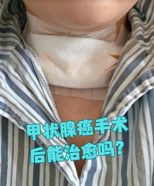 甲状腺肿瘤能治好吗