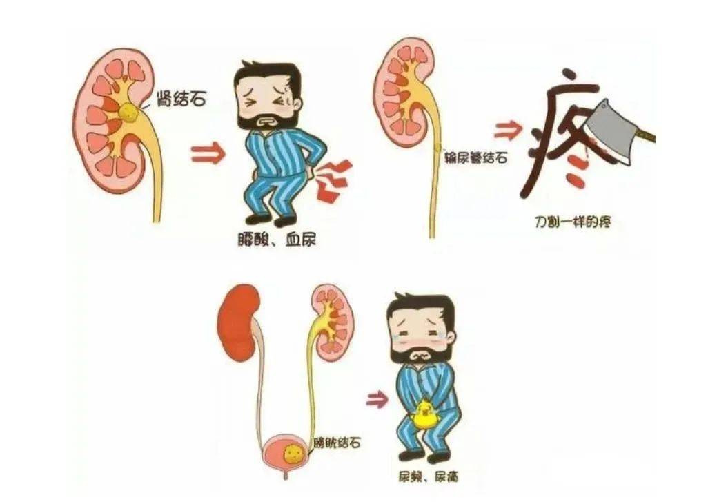 泌尿系结石的症状
