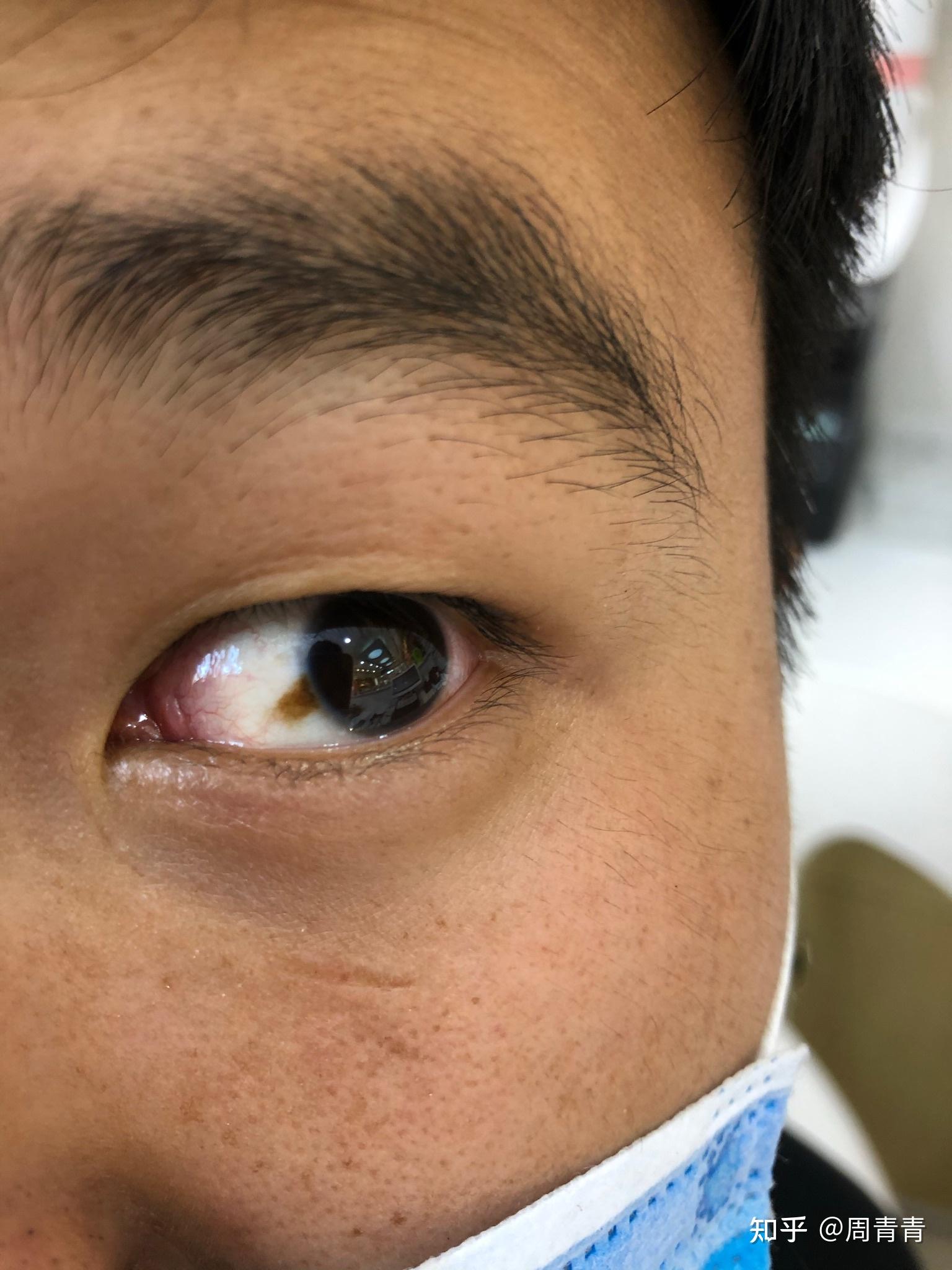 眼睛白眼球上有黄斑正常吗