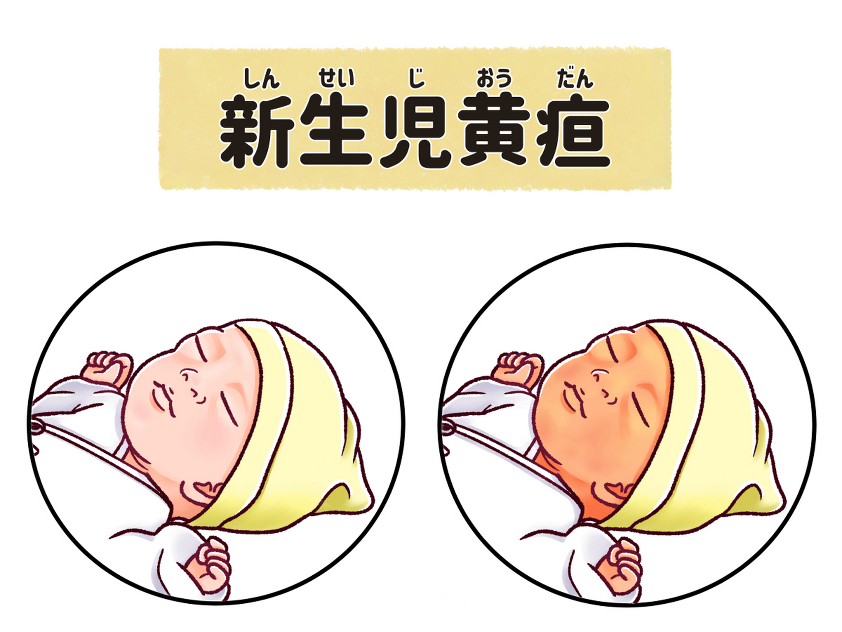 黄疸是什么