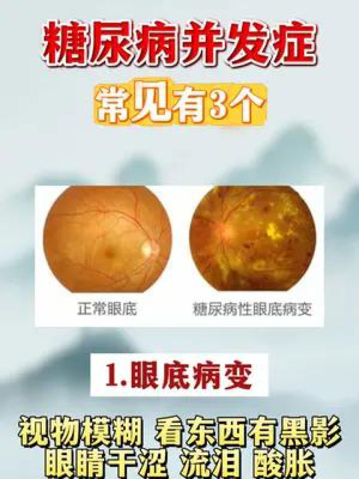 糖尿病并发症有哪些症状