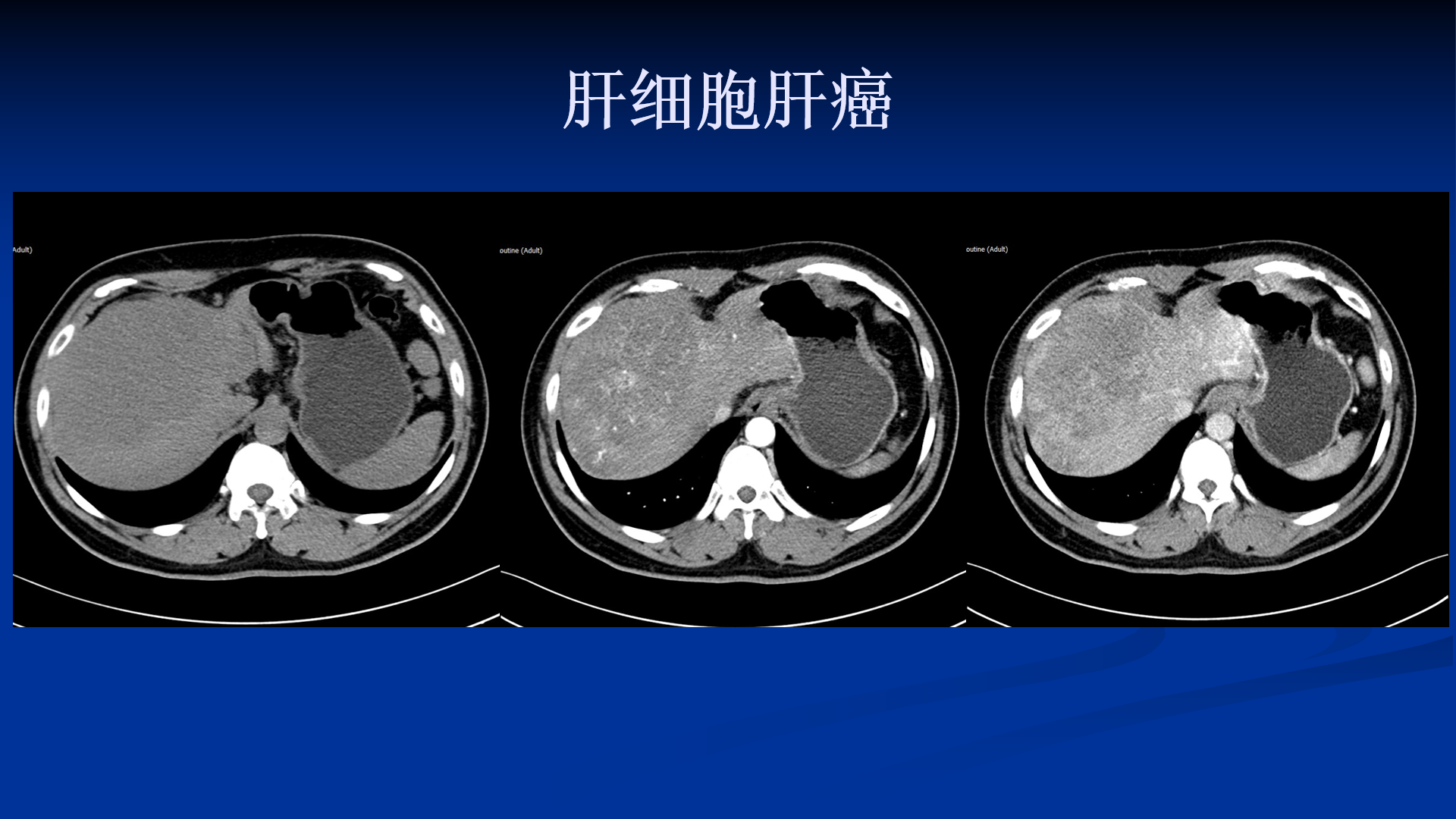 肝内胆管细胞癌是什么病
