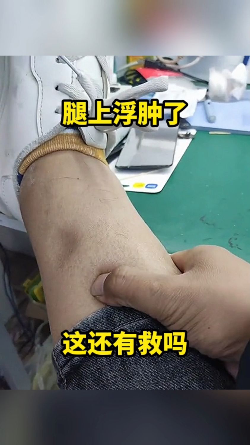 腿部水肿如何才能消除