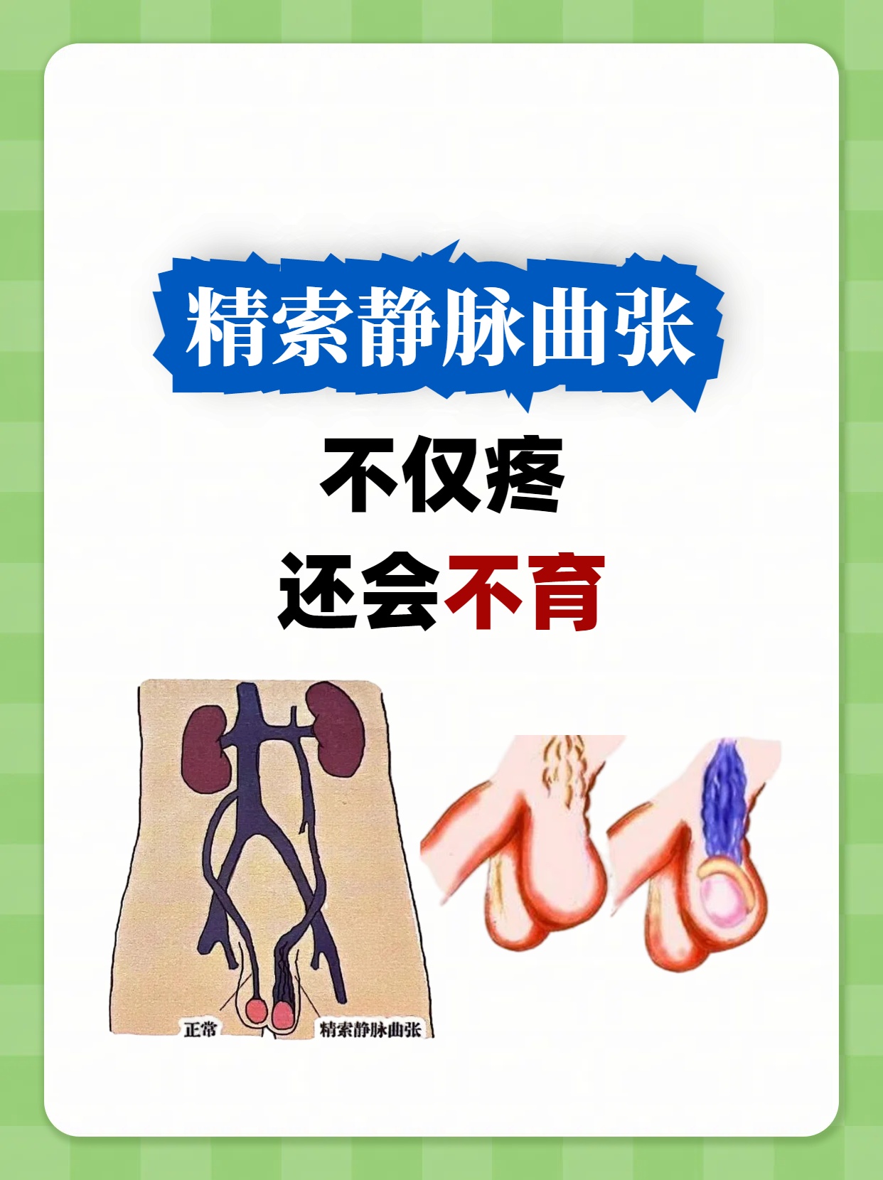 精索曲张是什么引起的