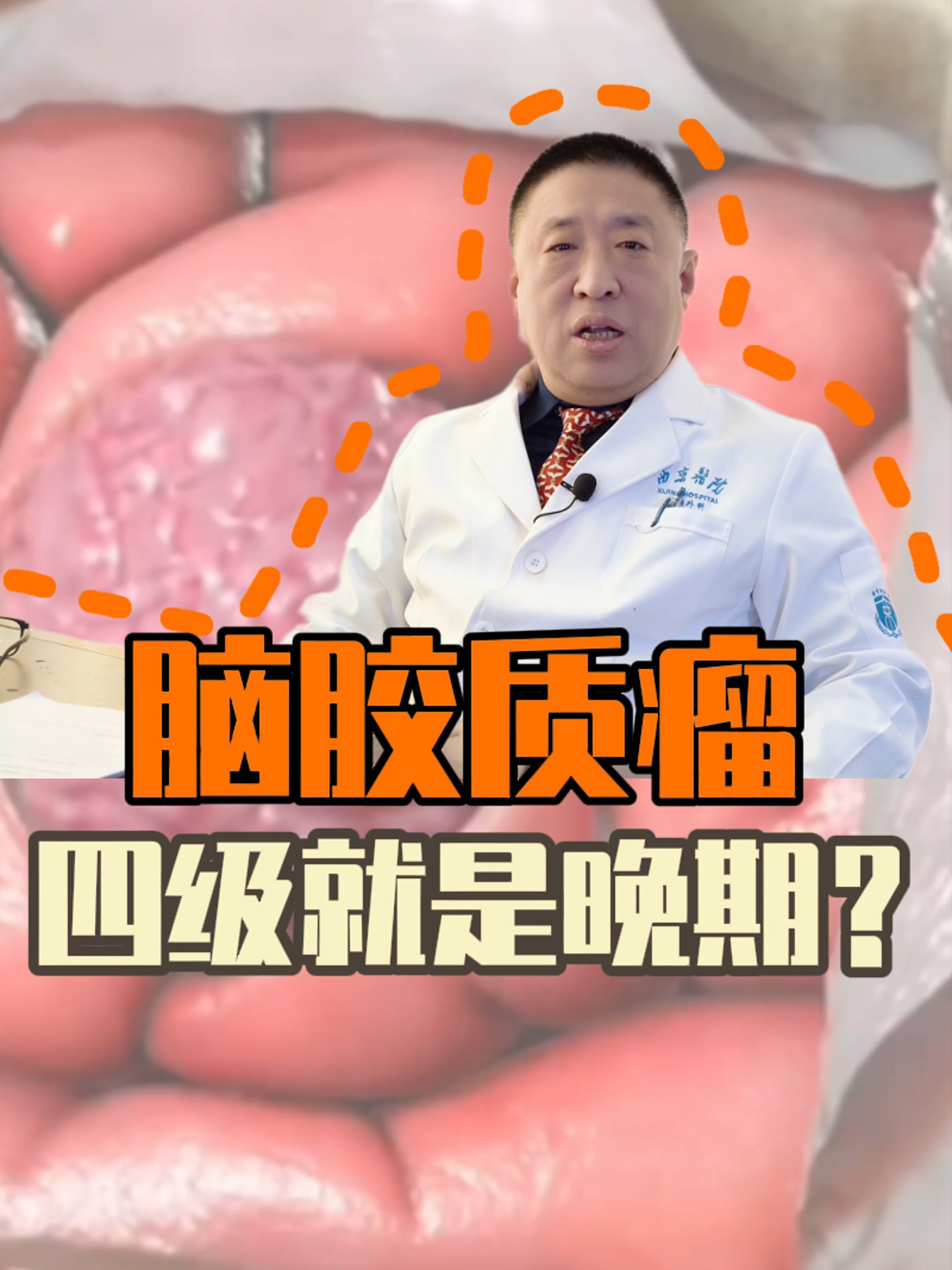 胶质瘤能治好吗?