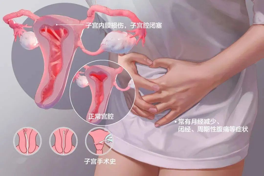 子宫粘连都有什么症状