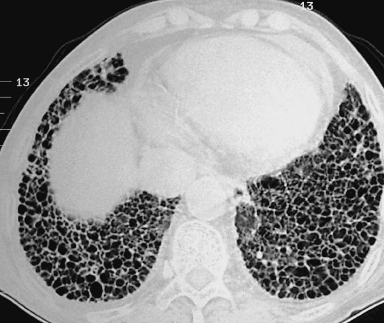 特发性肺纤维化严重吗