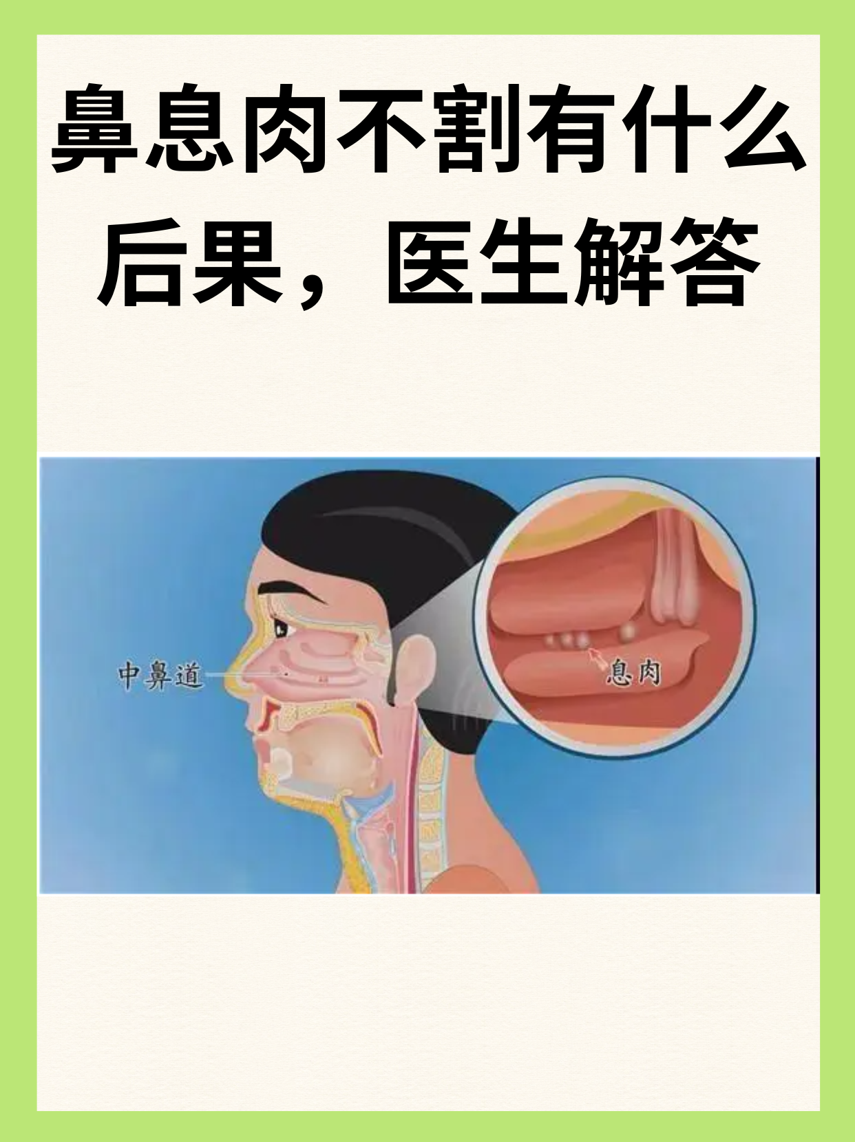 鼻息肉的治疗方法有哪些