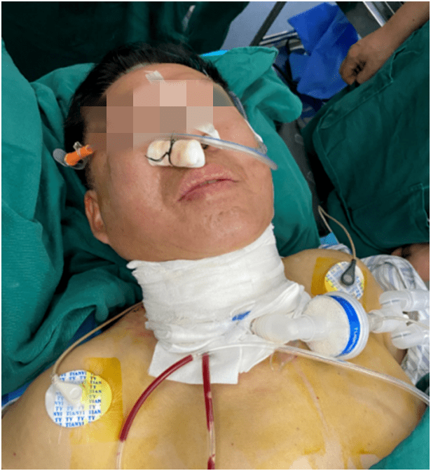 喉癌手术后能活几年