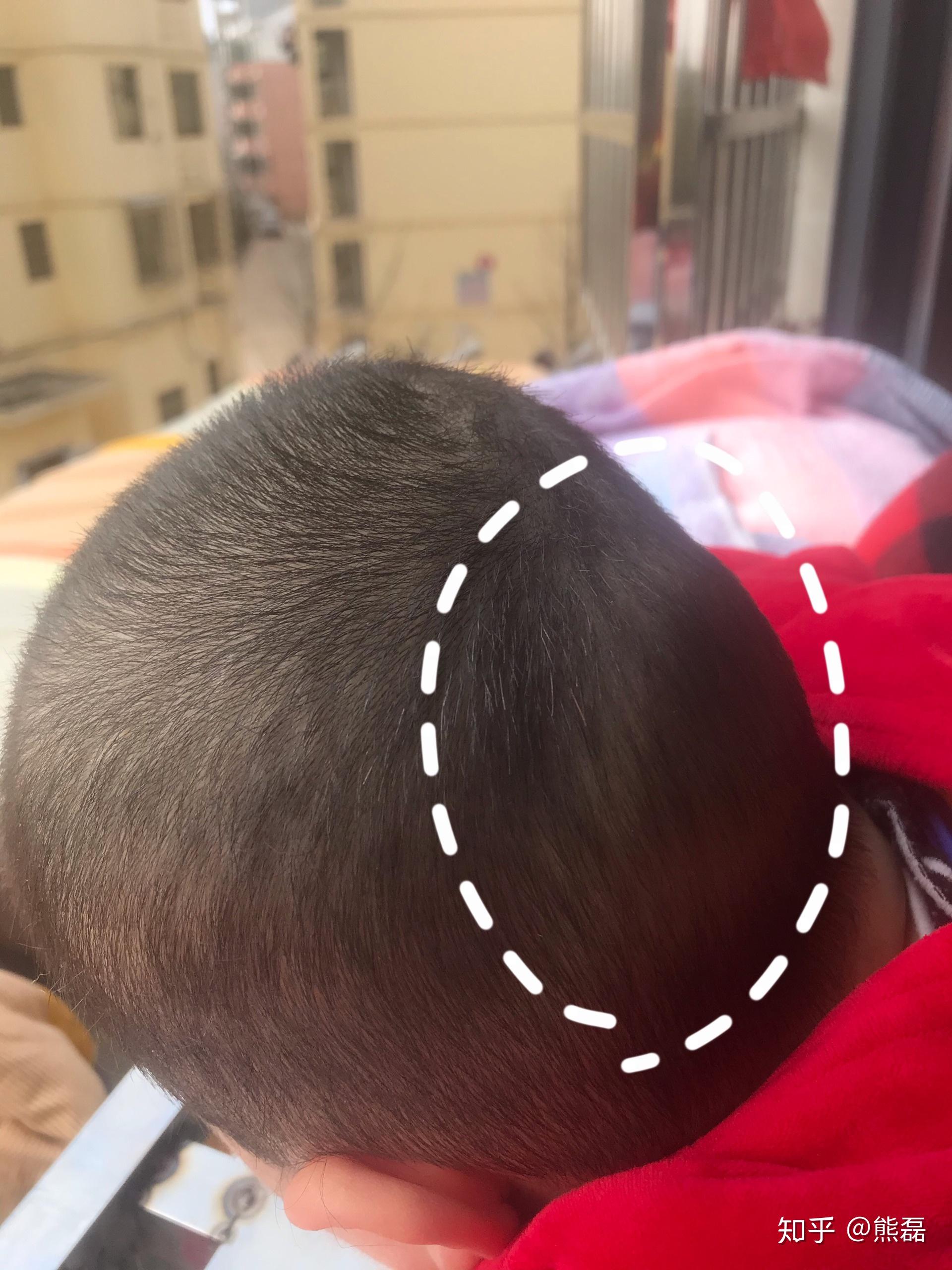 婴儿后脑勺有个坑
