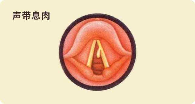 声带息肉什么原因会癌变吗?