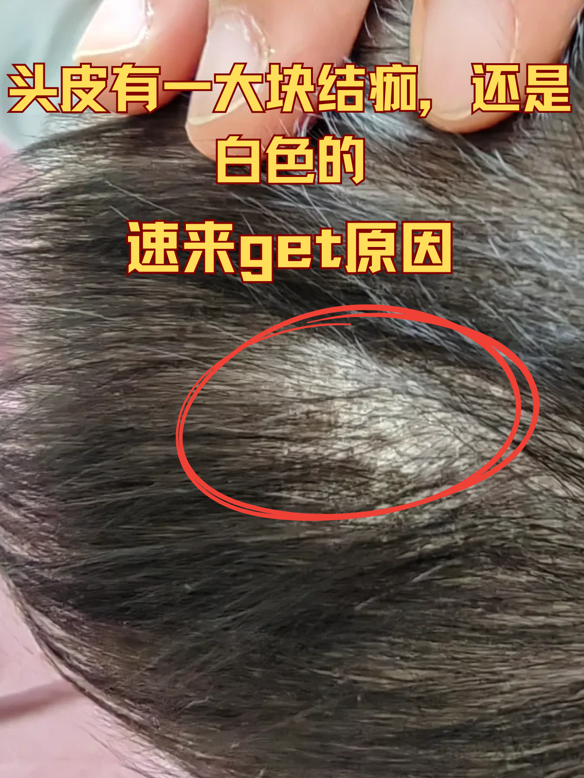 头皮上有白色的跟颗粒一样的