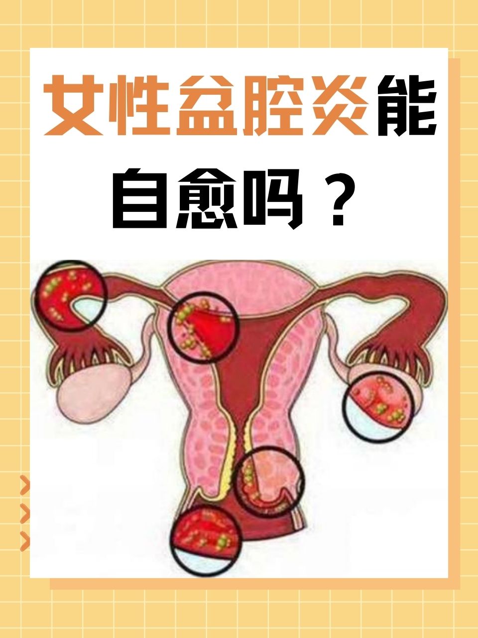 盆腔炎是怎么得