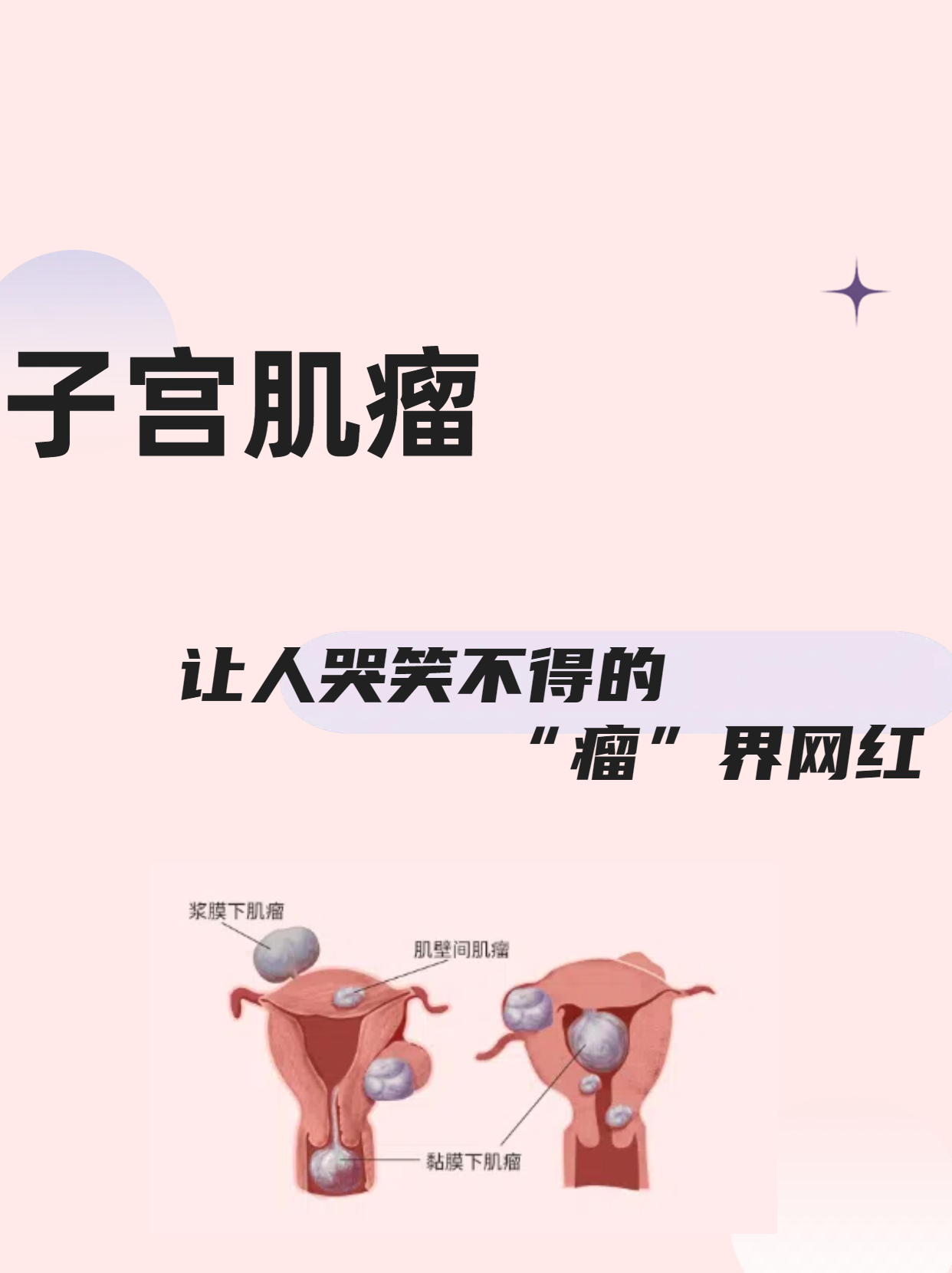 子宫肌瘤是什么意思