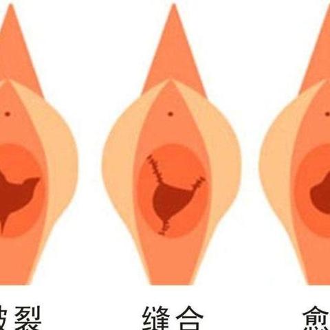 处女膜修复术