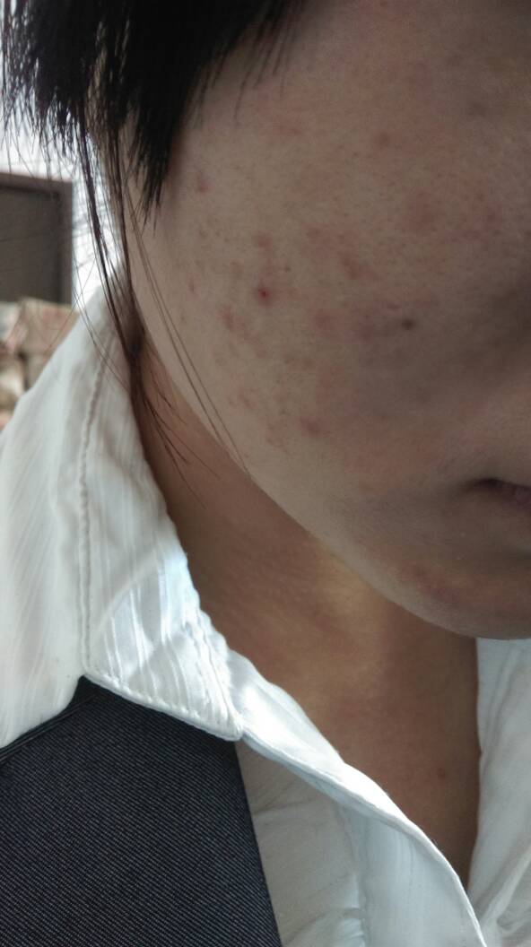 脸上长红疙瘩,不痛不痒