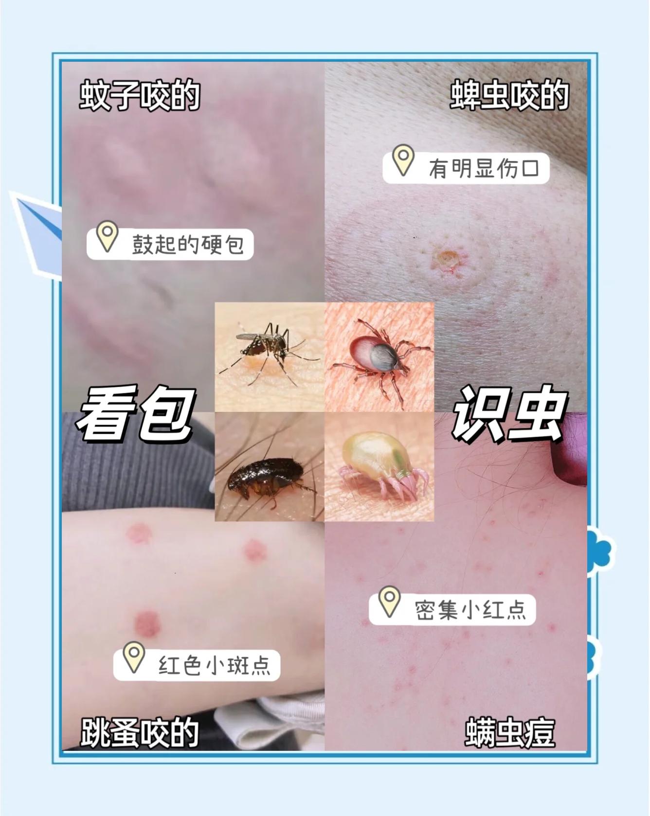 被毛毛虫蛰了怎么办.