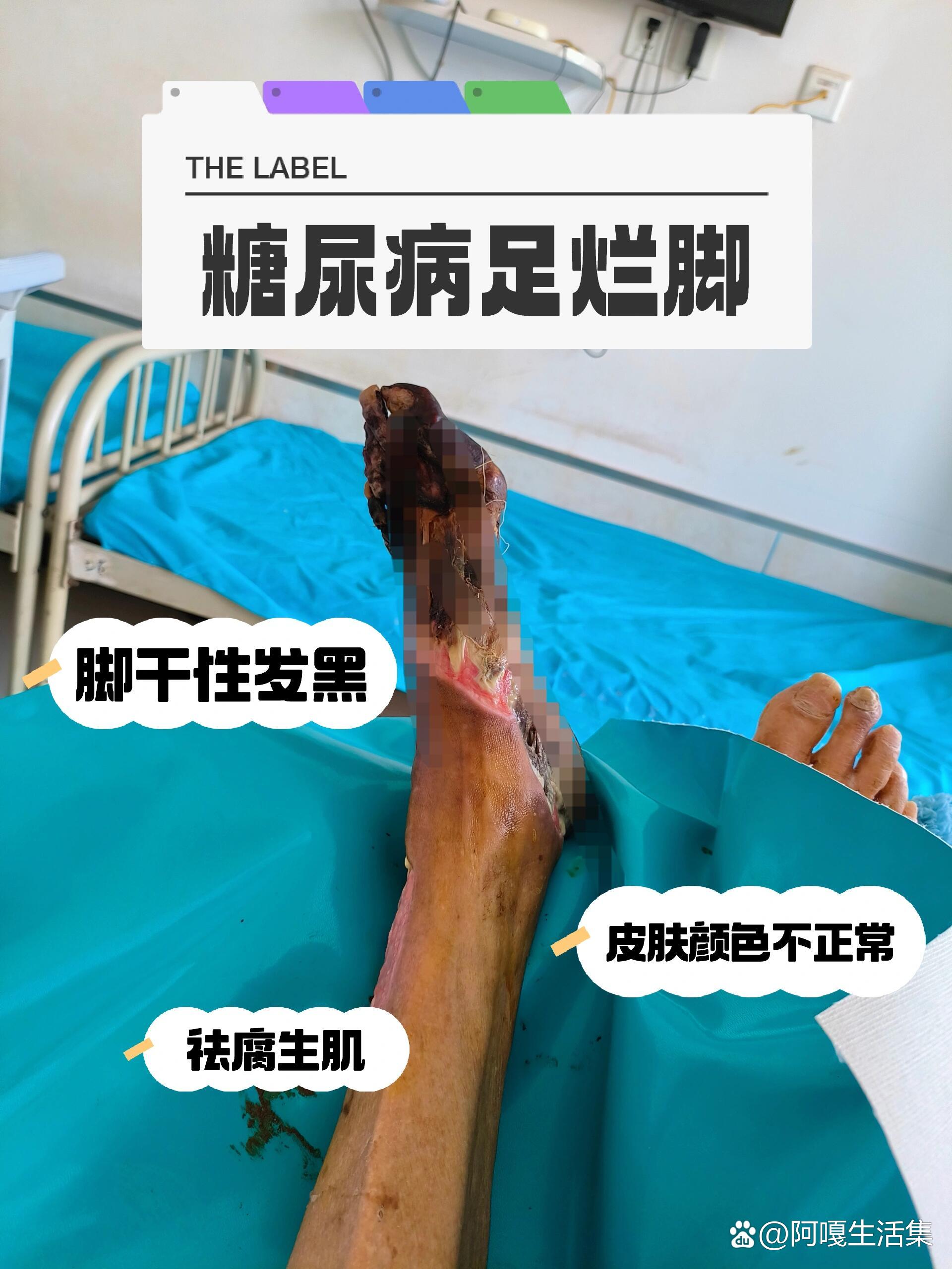 糖尿病足溃烂怎么办?