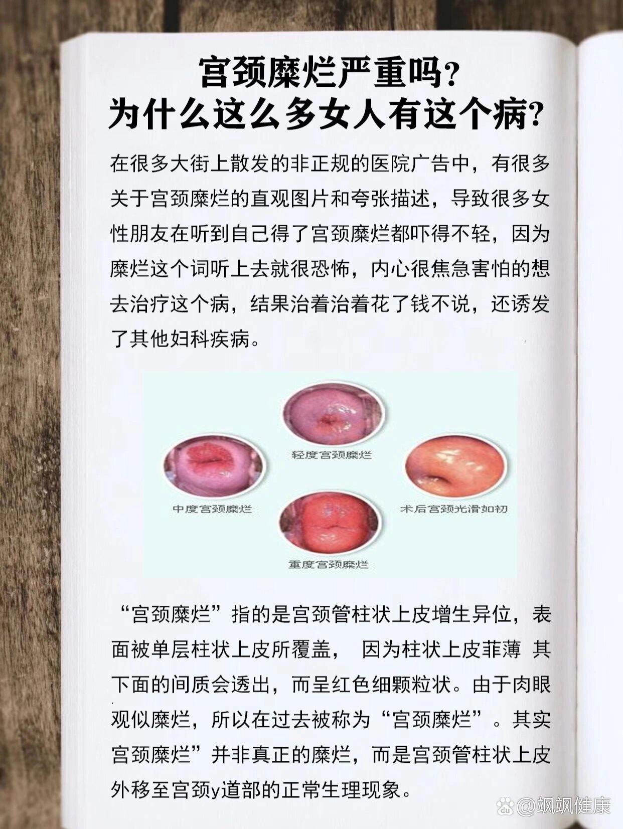 宫颈糜烂的治疗方法